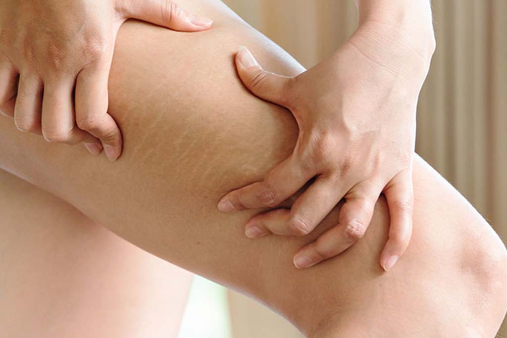 VERGETURES Camouflage de vergetures par pigmentation