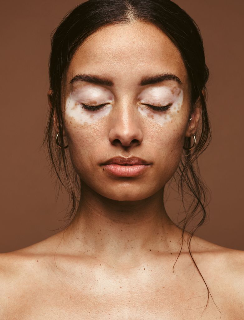 Vitiligo Camouflage du vitiligo par pigmentation dermique